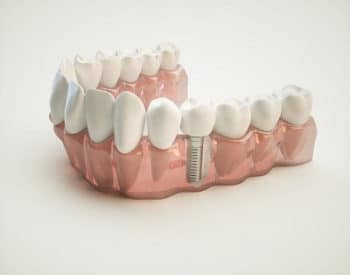 Dental Implants in Naperville, Illinois