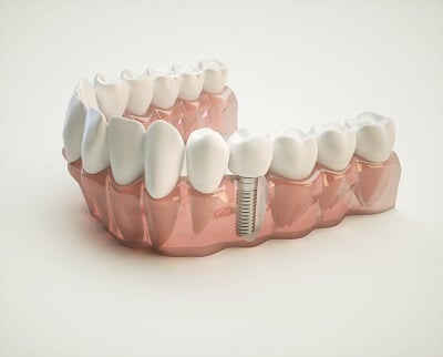 All-On-4®  Implants in Naperville, Illinois
