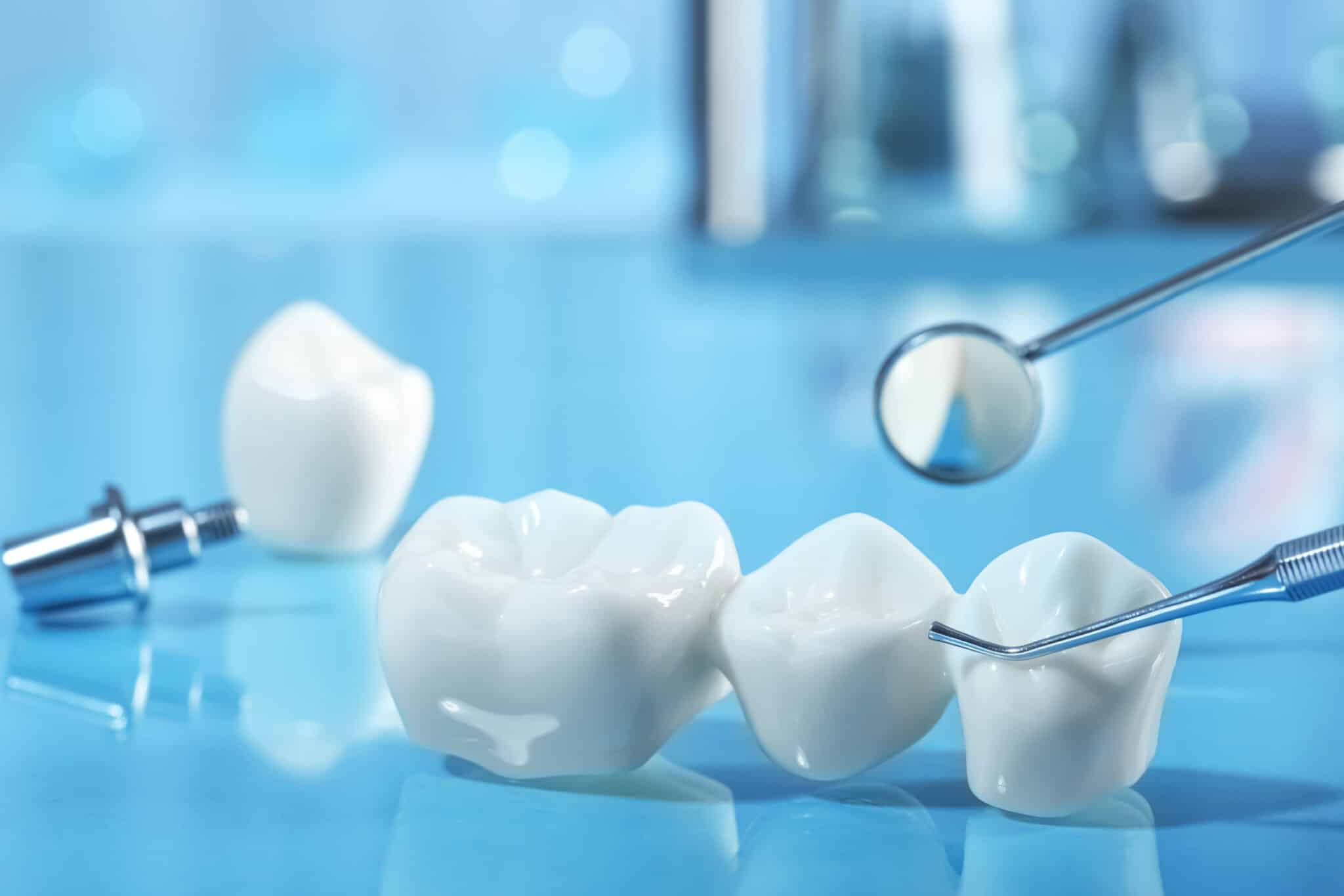Dental Bridges in Naperville, Illinois